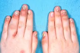 Reumatologista que trata artrite psoriásica