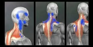 Reumatologista que trata Síndrome miofascial