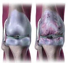 Médicos especialista em tratamento para artrose