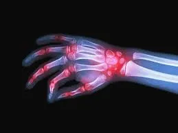 O melhor médico para tratamento de artrite