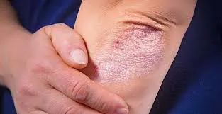 Tratamento de artrite psoriásica